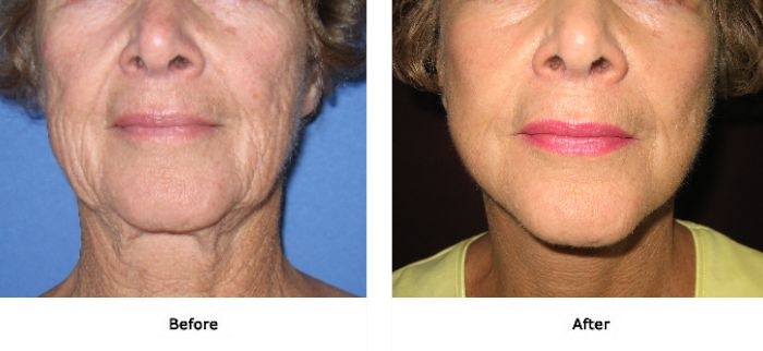 Facelift 3 Lift Plus Neck, Jowls and Midface