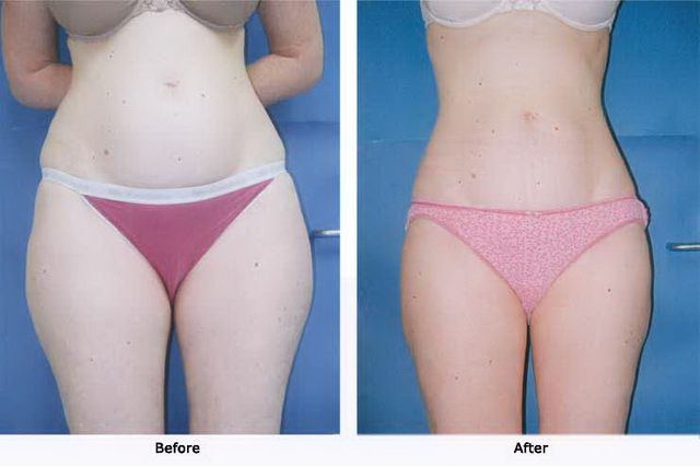 Liposuction 2 Flanks and Outer Thighs